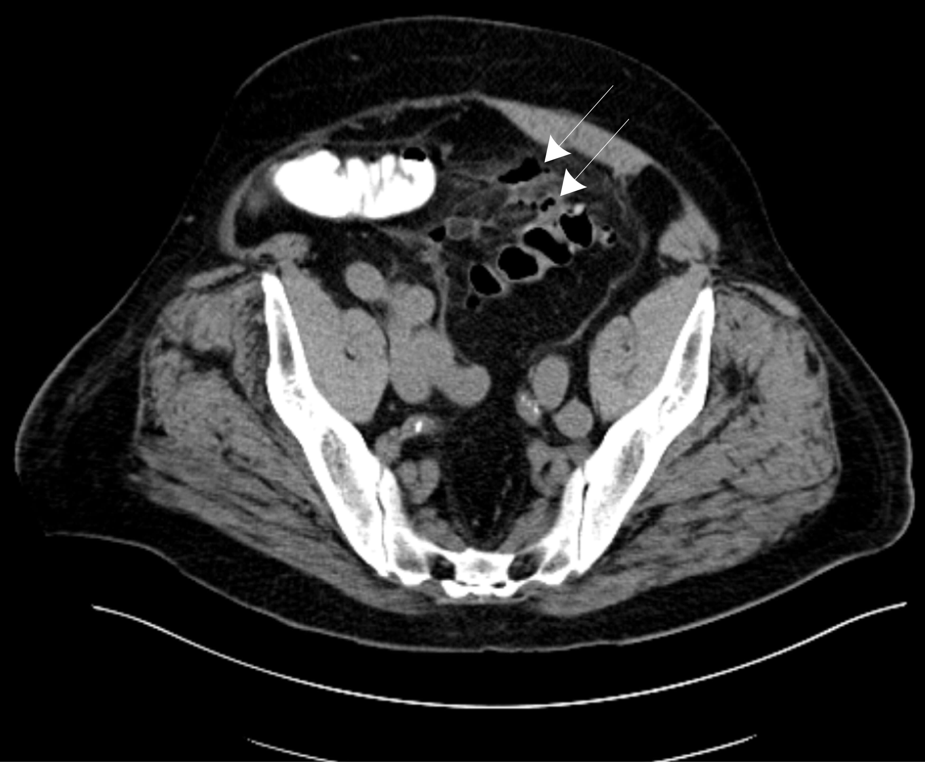 ACG 2021 Annual Meeting Posters