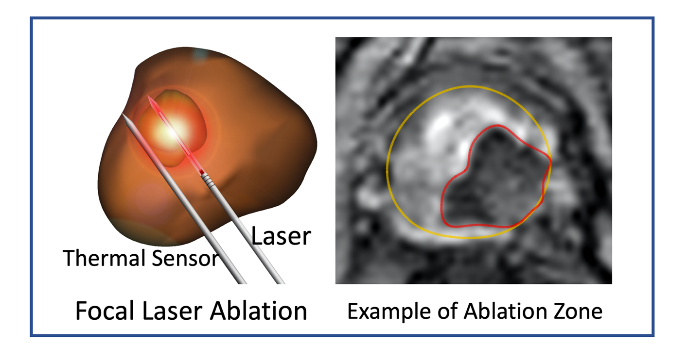 V14 04 Focal Laser Ablation Of Prostate Cancer An Office Procedure 9424